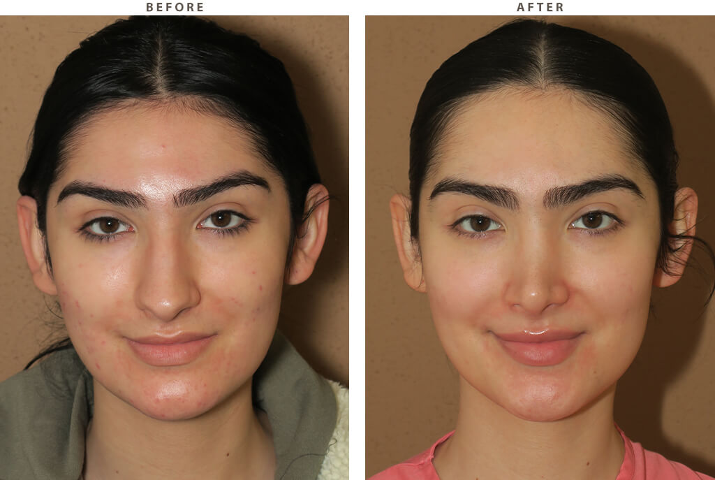 Facial feminization Chicago - Before and After Pictures