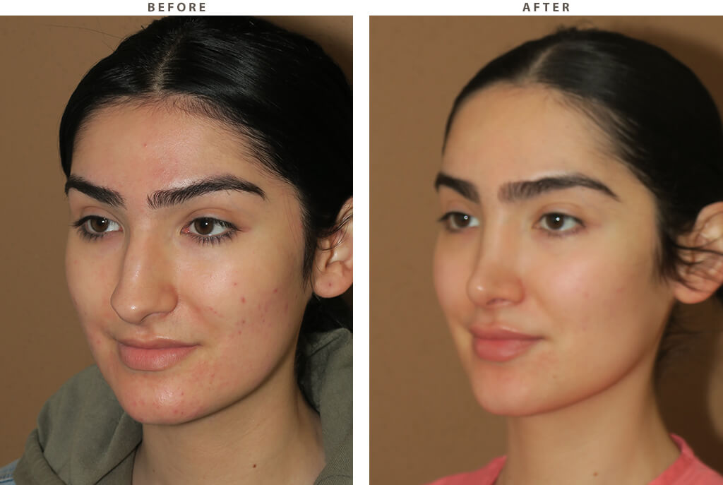 Facial feminization Chicago - Before and After Pictures