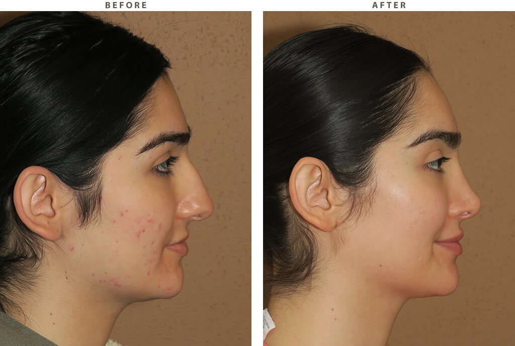 Facial feminization Chicago - Before and After Pictures