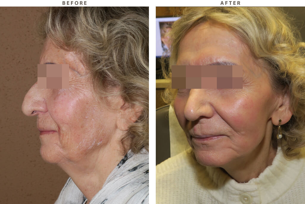 Laser resurfacing - Before and After Pictures