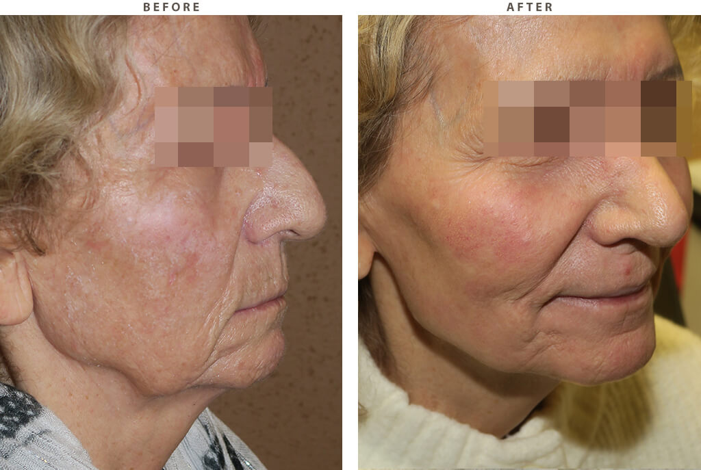 Laser resurfacing - Before and After Pictures