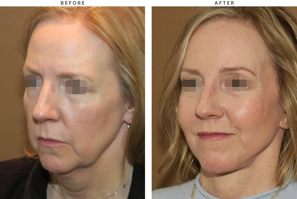 Complex Facial Rejuvenation Chicago - Before and After Pictures