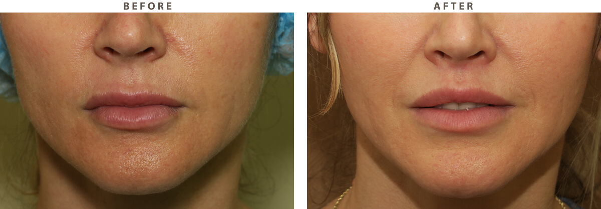 Lip lift Chicago - Before and After Pictures