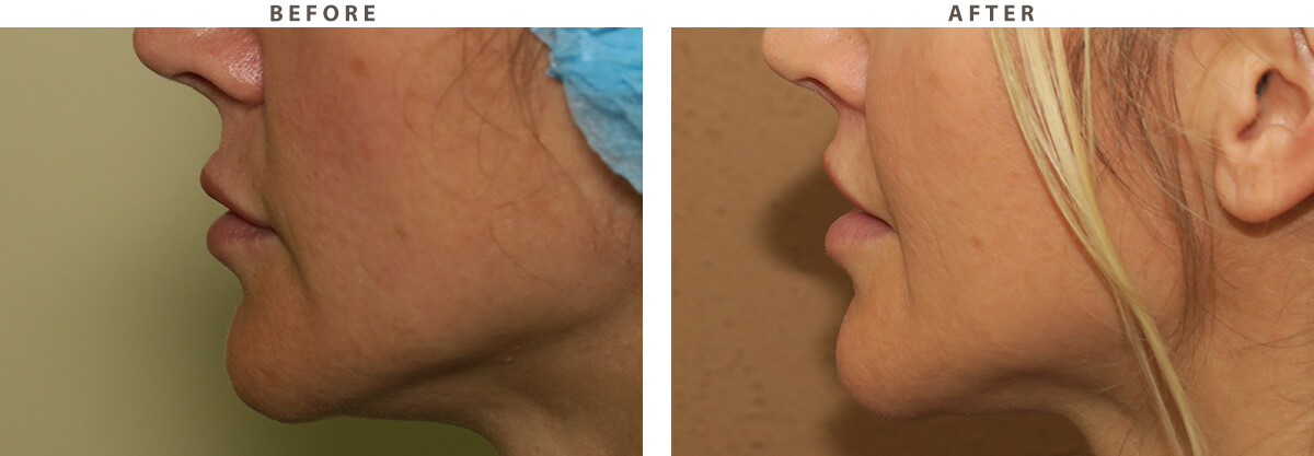 Lip lift Chicago - Before and After Pictures