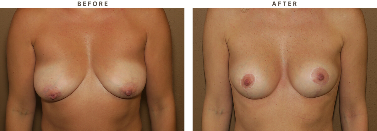 Breast lift Chicago - Before and After Pictures