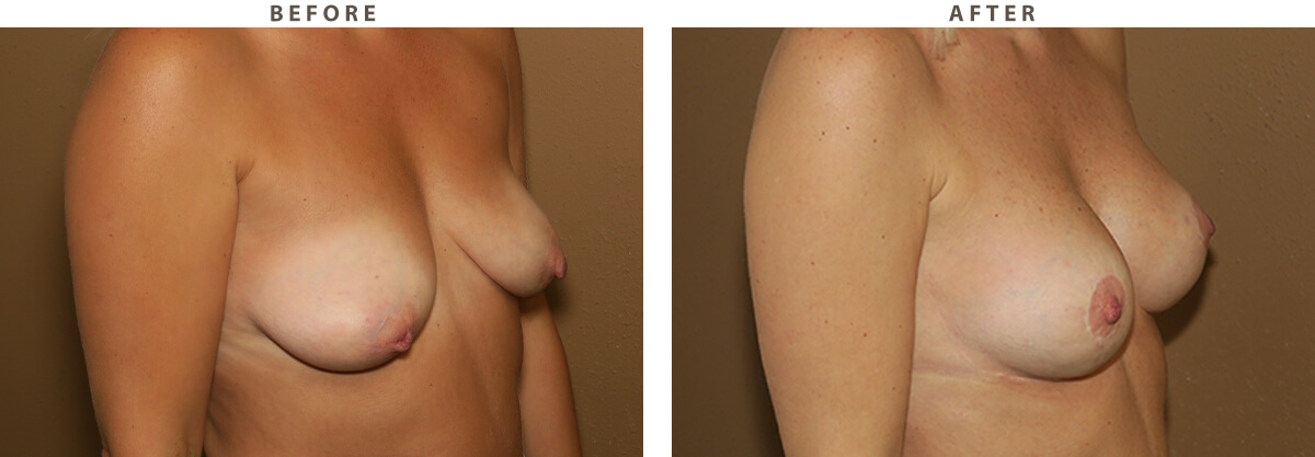 Breast lift Chicago - Before and After Pictures