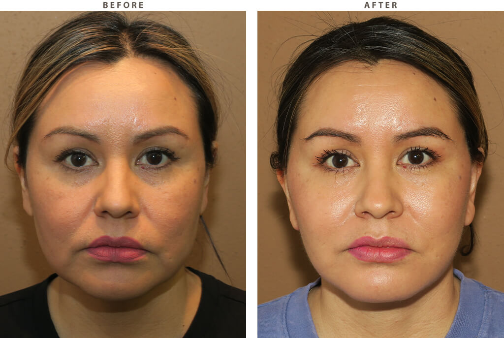 Midface lift Chicago - Before and After Pictures