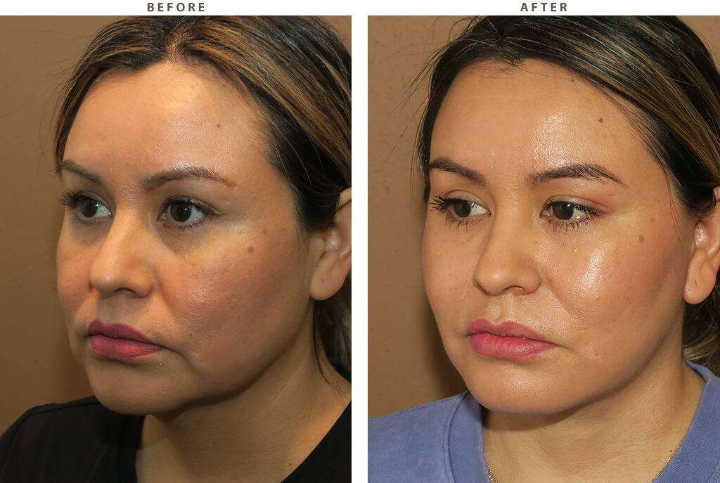 Midface lift Chicago - Before and After Pictures