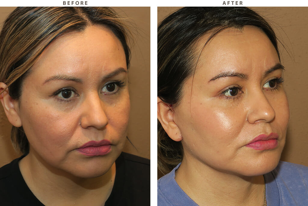Midface lift Chicago - Before and After Pictures