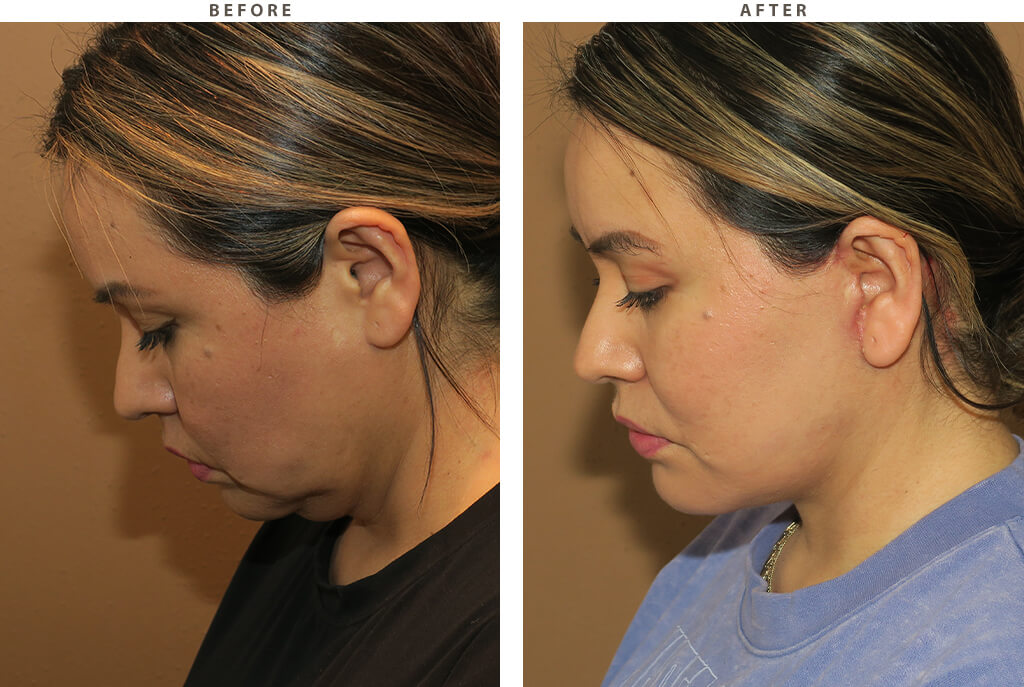 Midface lift Chicago - Before and After Pictures