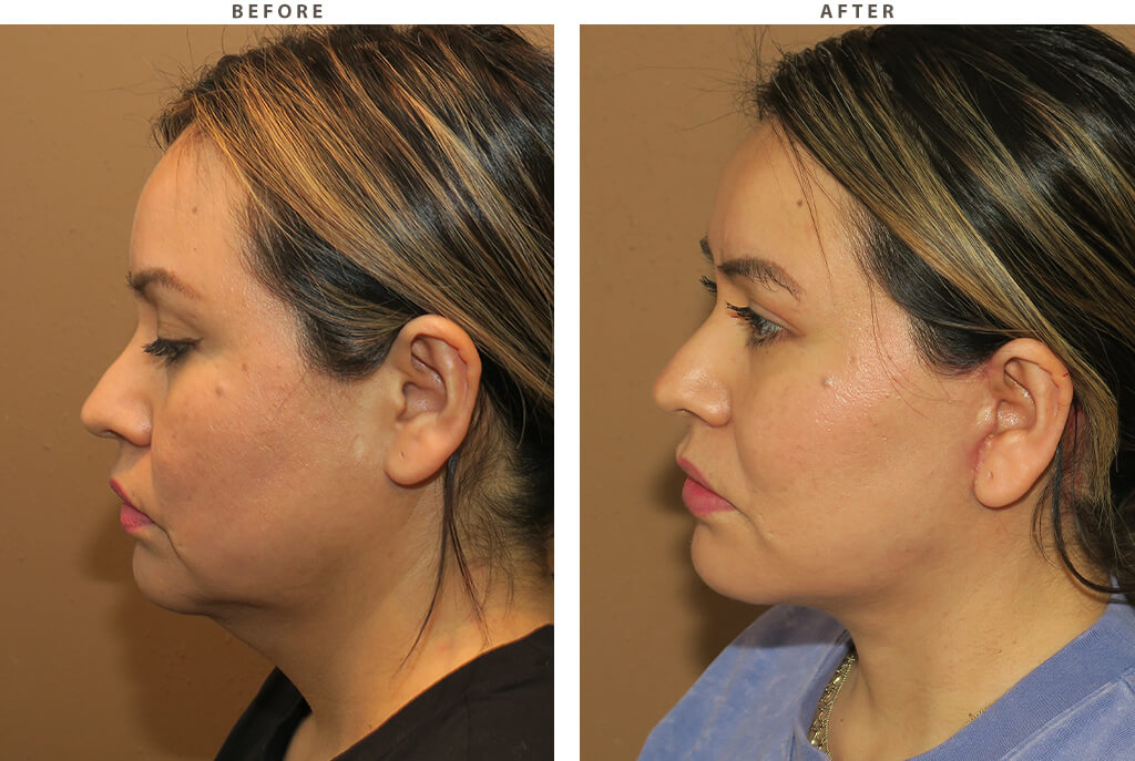 Midface lift Chicago - Before and After Pictures