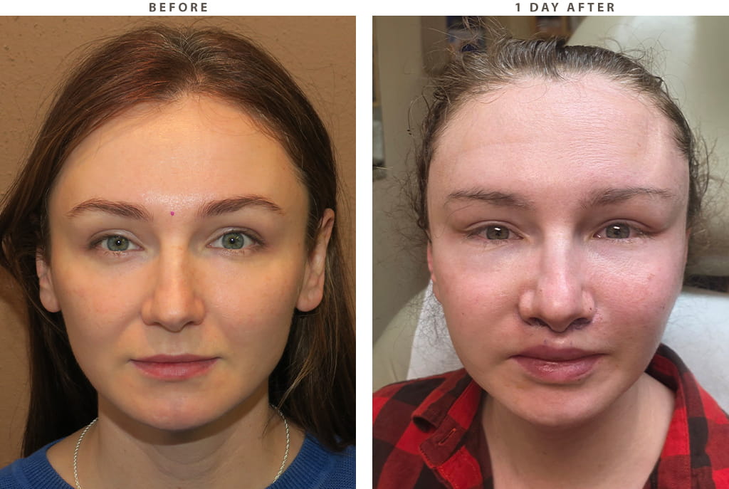 Midface lift Chicago - Before and After Pictures