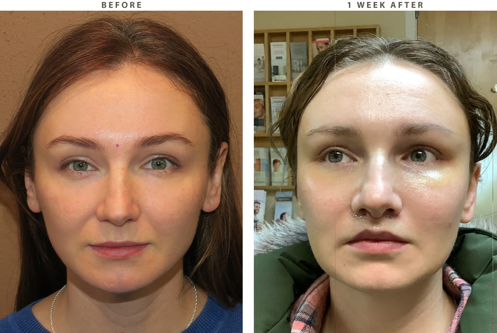 Midface lift Chicago - Before and After Pictures