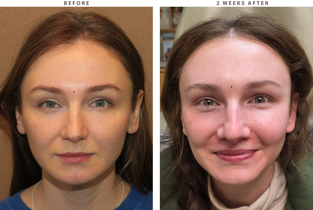 Midface lift Chicago - Before and After Pictures