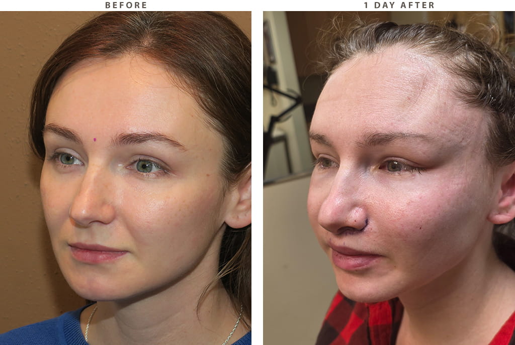 Midface lift Chicago - Before and After Pictures