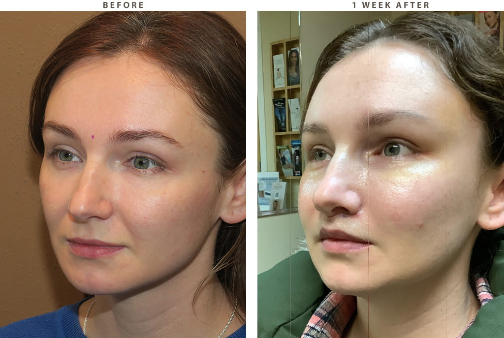 Midface lift Chicago - Before and After Pictures