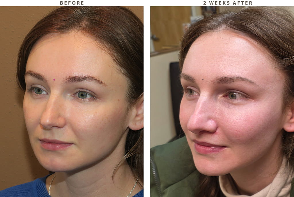 Midface lift Chicago - Before and After Pictures