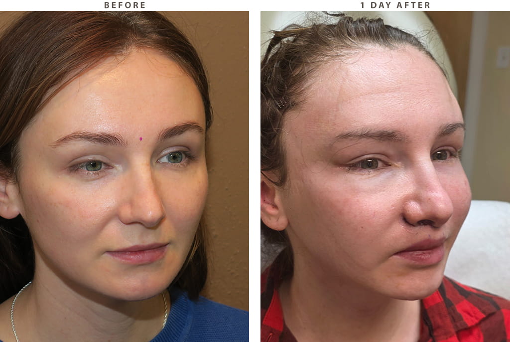 Midface lift Chicago - Before and After Pictures
