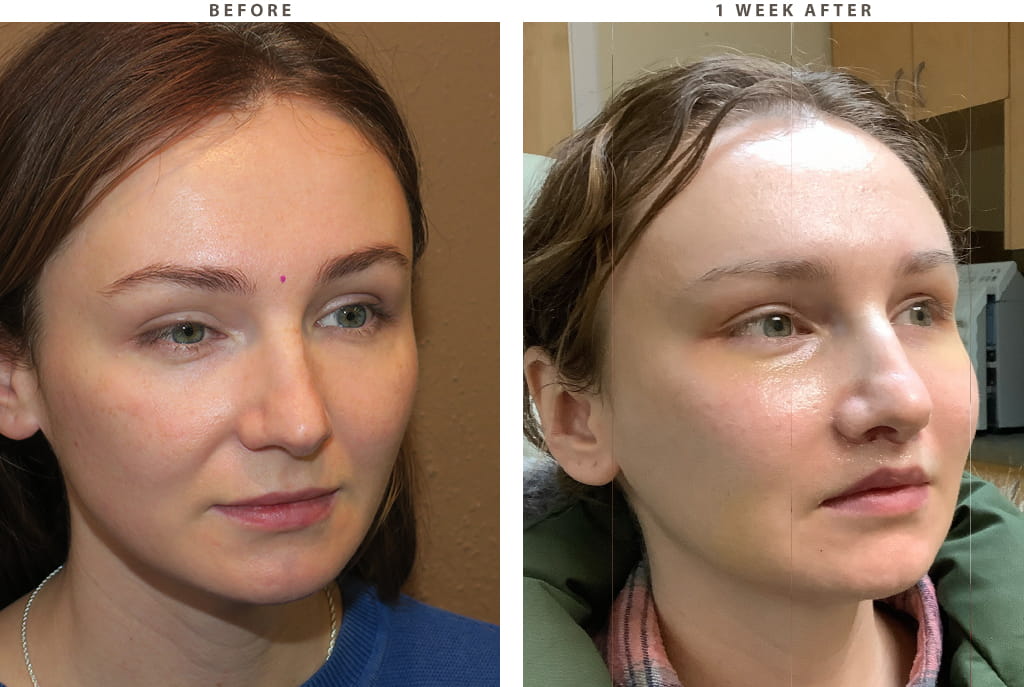 Midface lift Chicago - Before and After Pictures