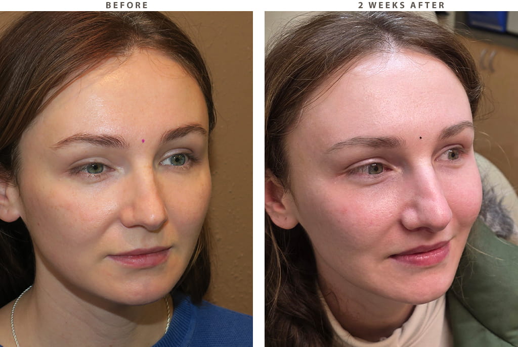 Midface lift Chicago - Before and After Pictures