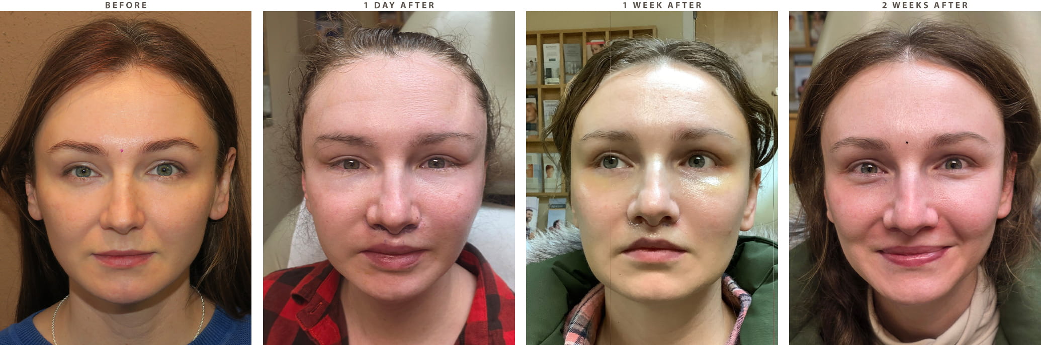 Midface lift Chicago - Before and After Pictures