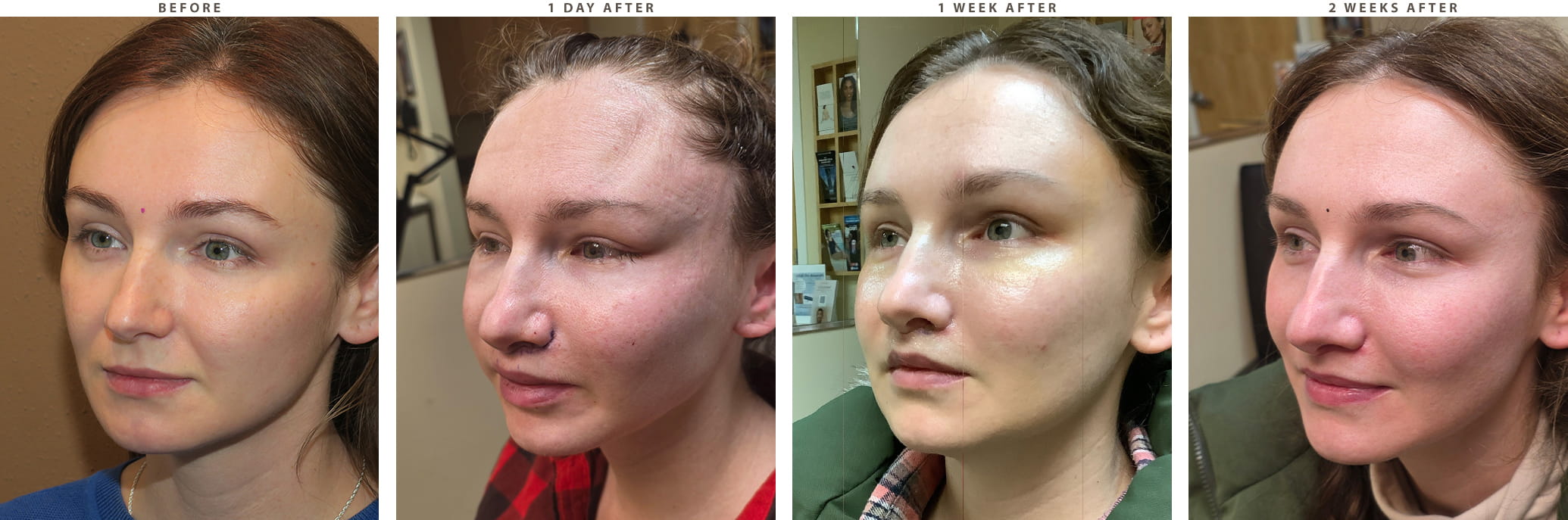 Midface lift Chicago - Before and After Pictures