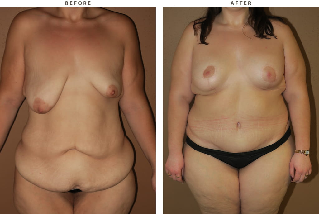 Mommy Makeover - Before and After Pictures