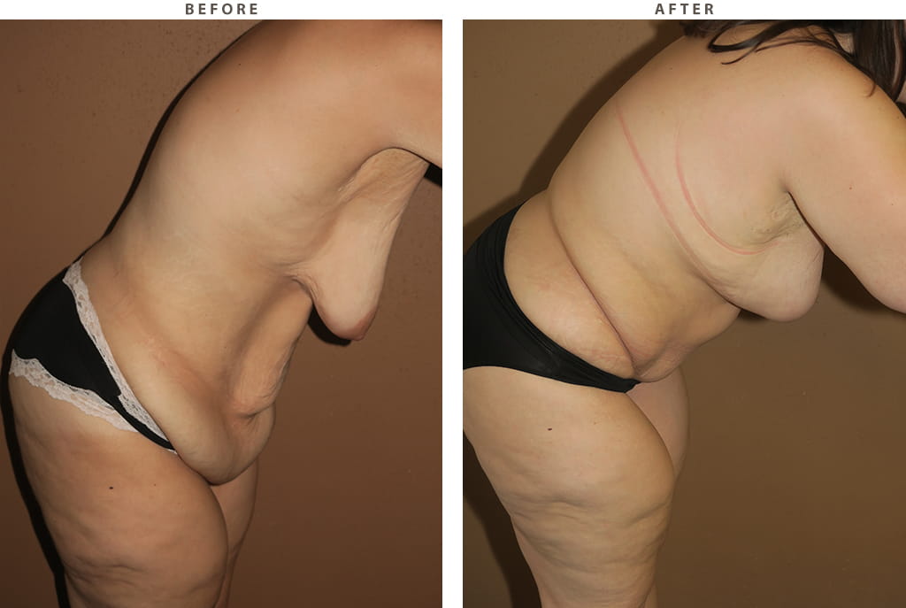 Mommy Makeover - Before and After Pictures