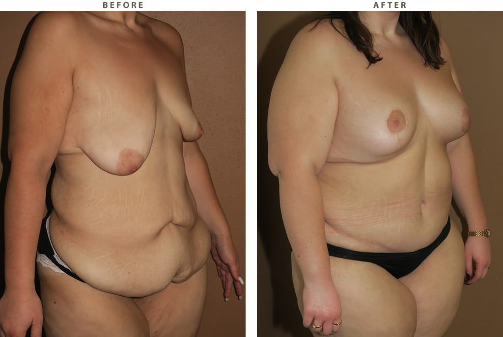 Mommy Makeover - Before and After Pictures