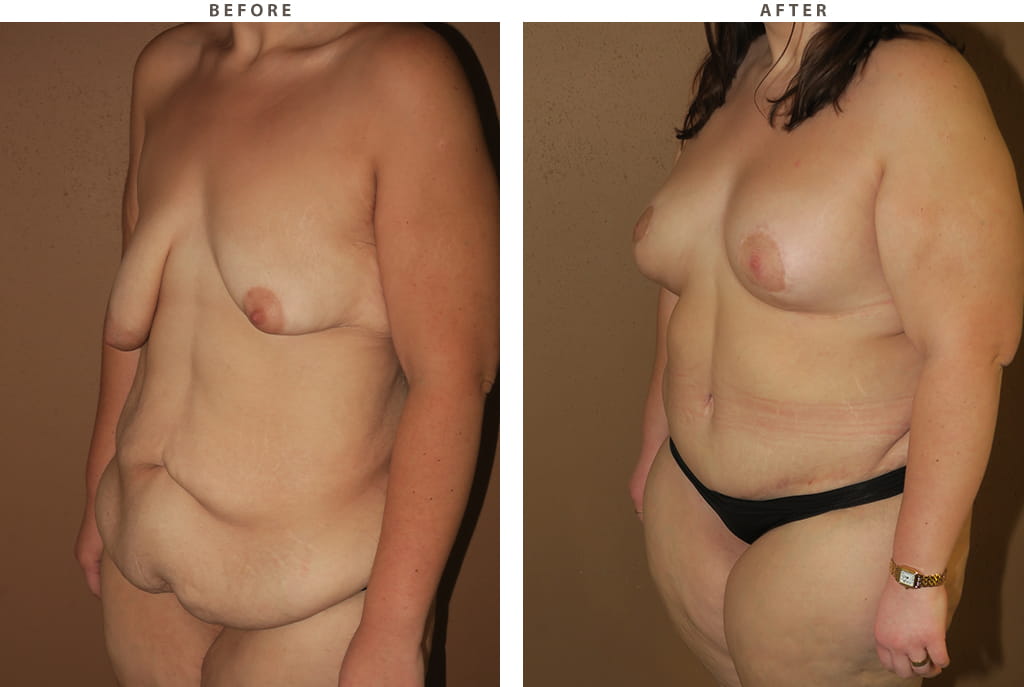 Mommy Makeover - Before and After Pictures