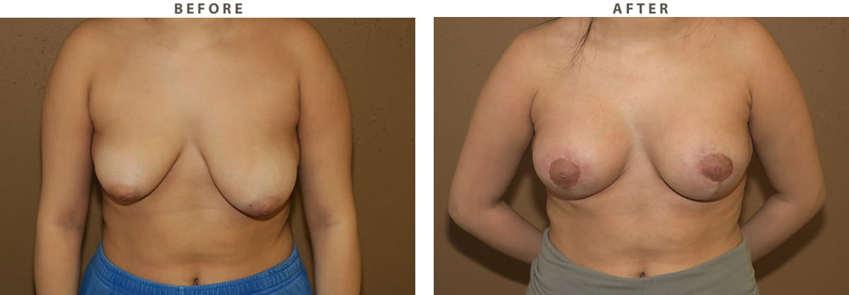 Breast Lift Chicago - Before and After Pictures