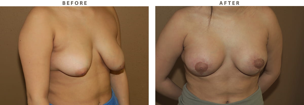 Breast Lift Chicago - Before and After Pictures