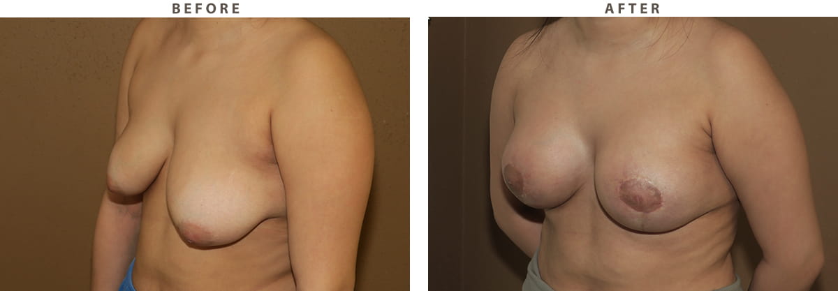 Breast Lift Chicago - Before and After Pictures