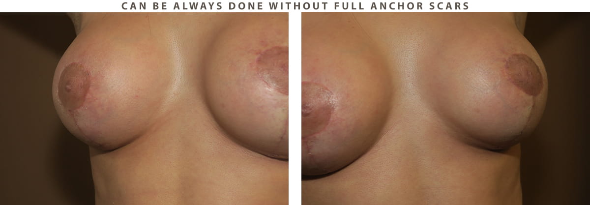 Breast Lift Chicago - Before and After Pictures