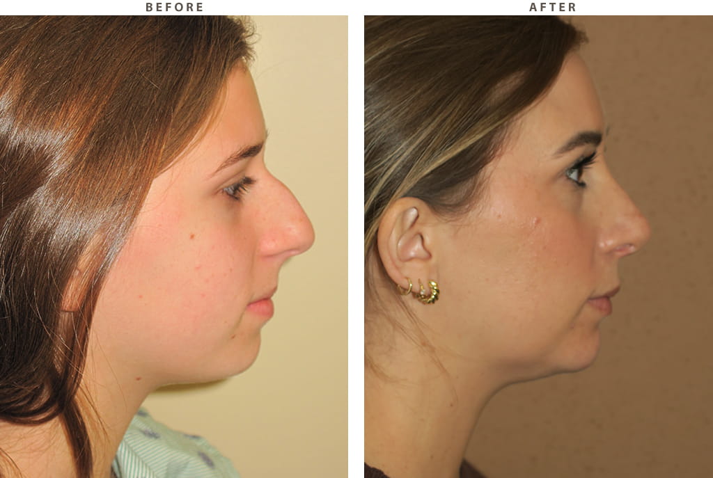 Rhinoplasty Chicago - Before and After Pictures