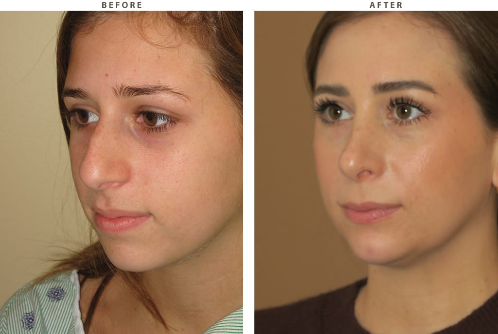 Rhinoplasty Chicago - Before and After Pictures