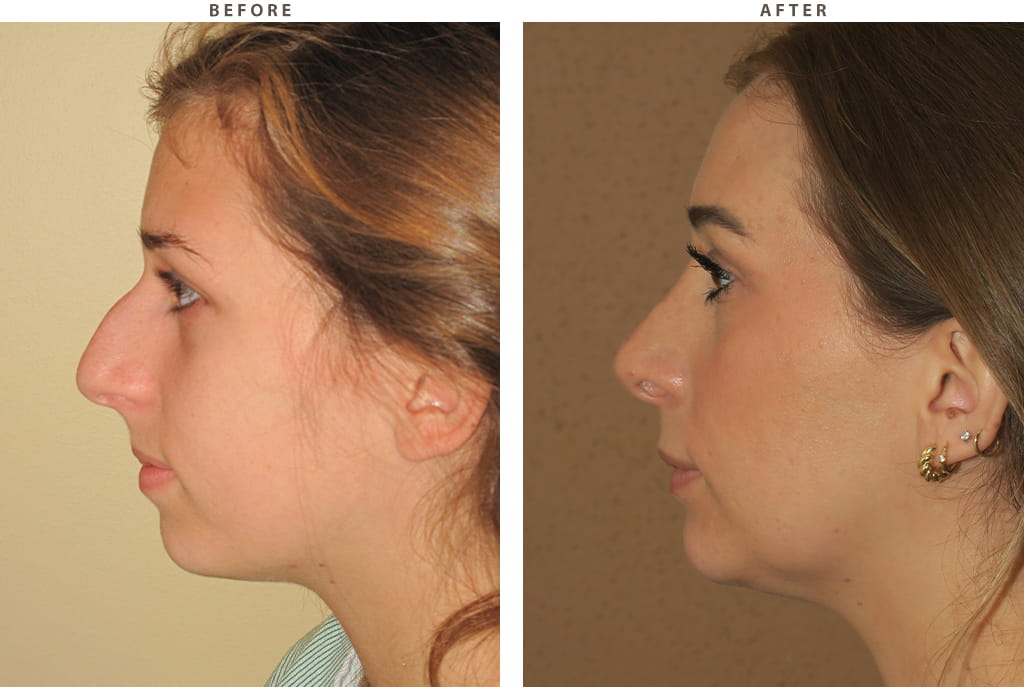 Rhinoplasty Chicago - Before and After Pictures