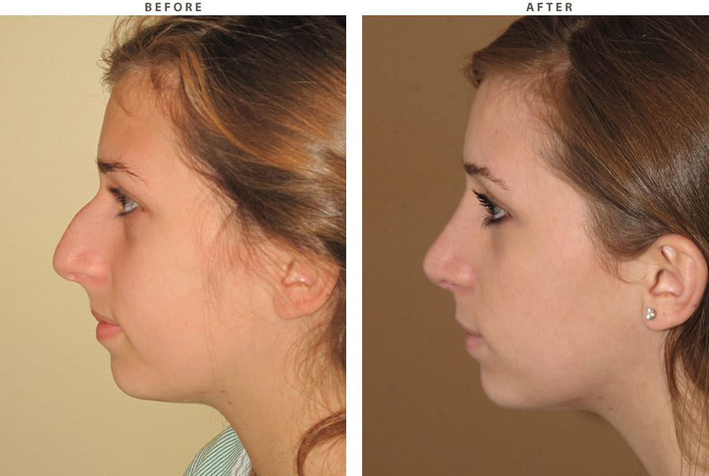 Rhinoplasty Chicago - Before and After Pictures