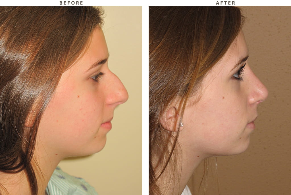 Rhinoplasty Chicago - Before and After Pictures