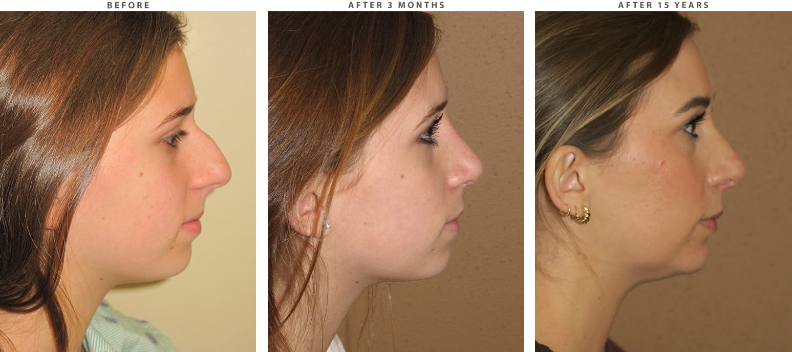 Rhinoplasty Chicago - Before and After Pictures