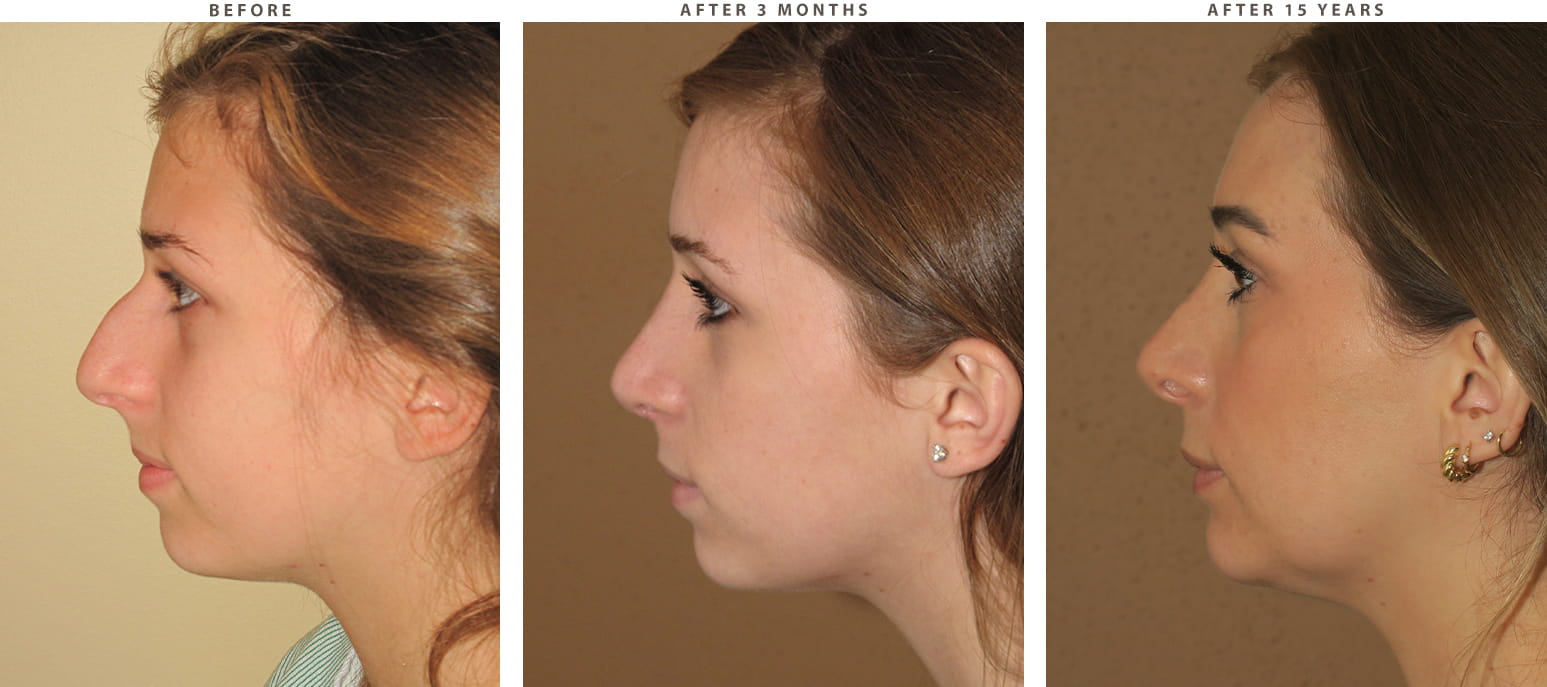 Rhinoplasty Chicago - Before and After Pictures