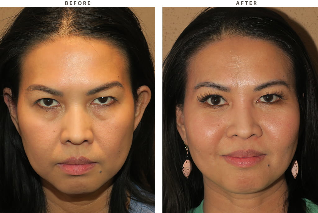 Midface lift Chicago - Before and After Pictures