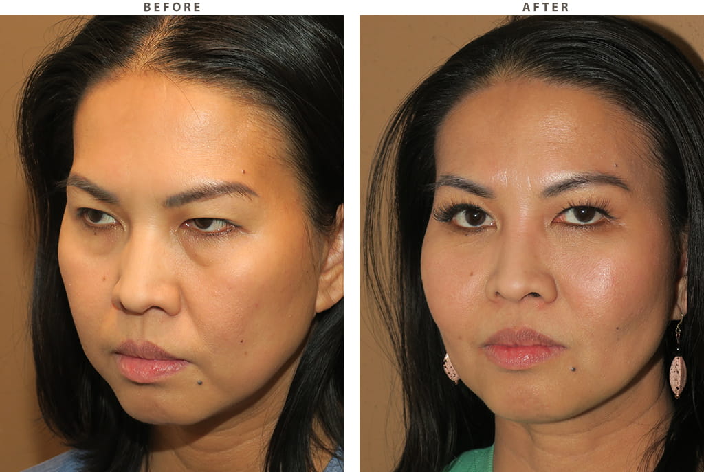 Midface lift Chicago - Before and After Pictures