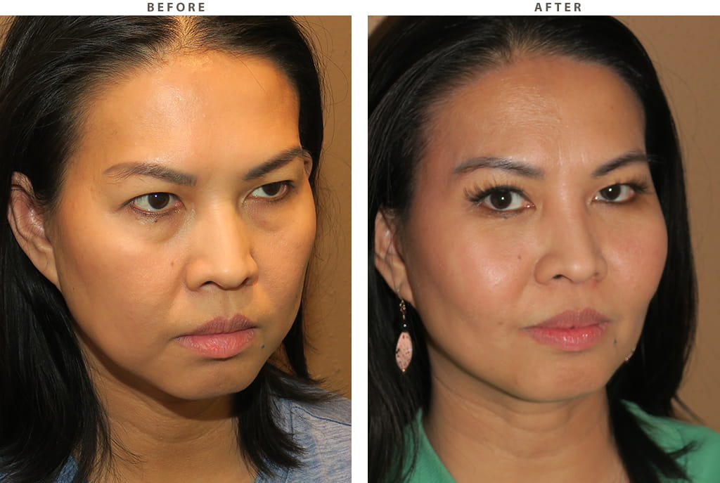 Midface lift Chicago - Before and After Pictures
