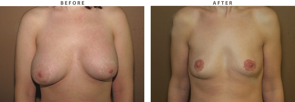 Implant removal Chicago - Before and After Pictures