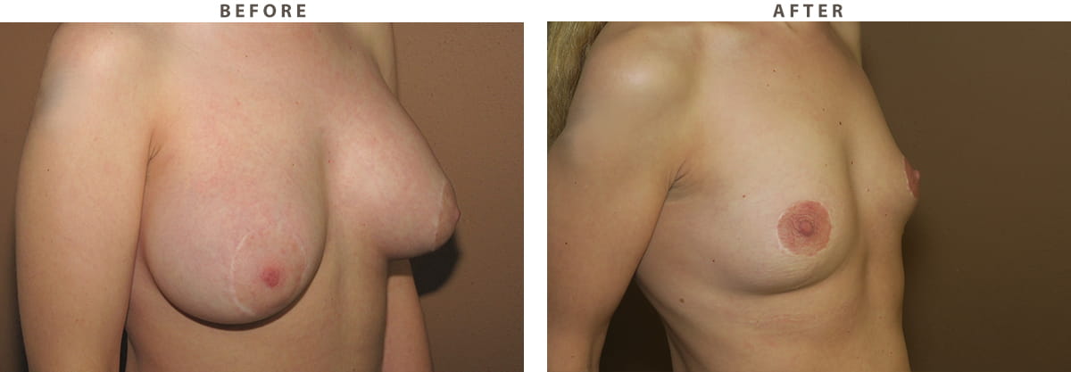 Implant removal Chicago - Before and After Pictures