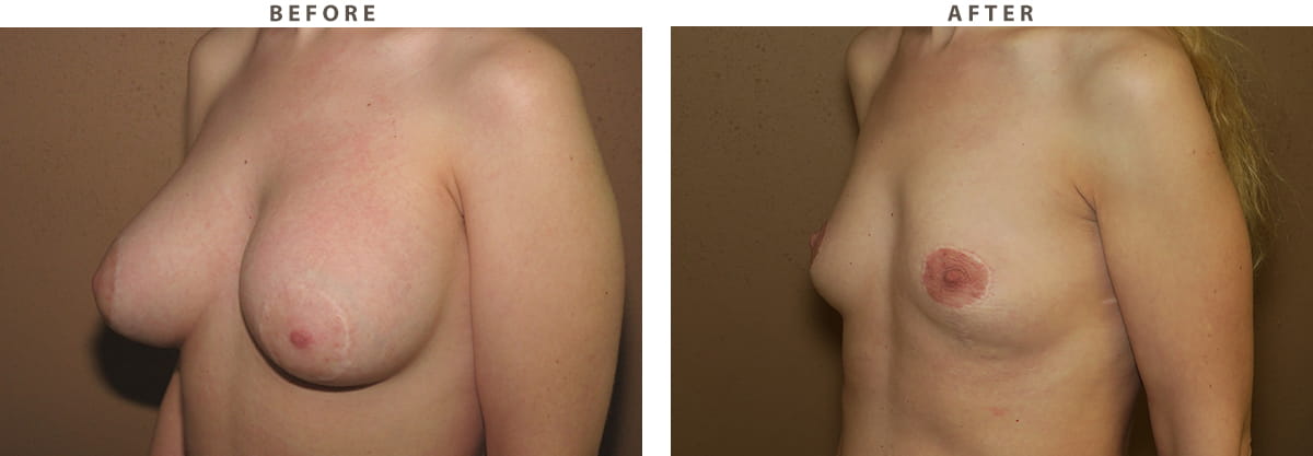 Implant removal Chicago - Before and After Pictures