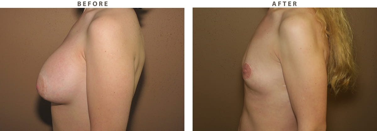 Implant removal Chicago - Before and After Pictures