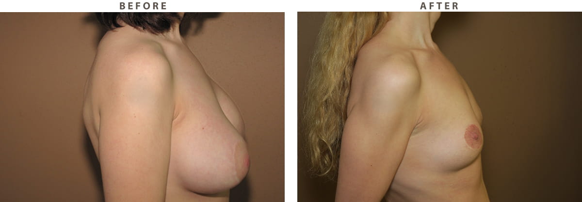 Implant removal Chicago - Before and After Pictures