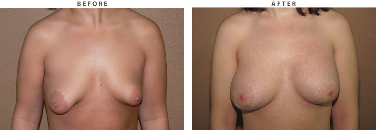 Tuberous breast Chicago - Before and After Pictures